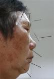 Acupuncture beats drug to treat hot flashes: study